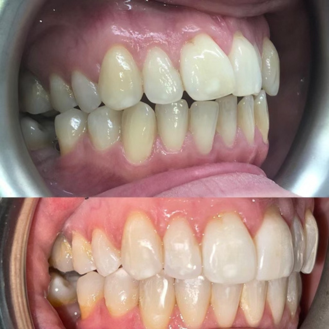 Invisalign Teeth Straightening Dental Treatment John Holmes Swaffham Kings Lynn Norfolk Norwich