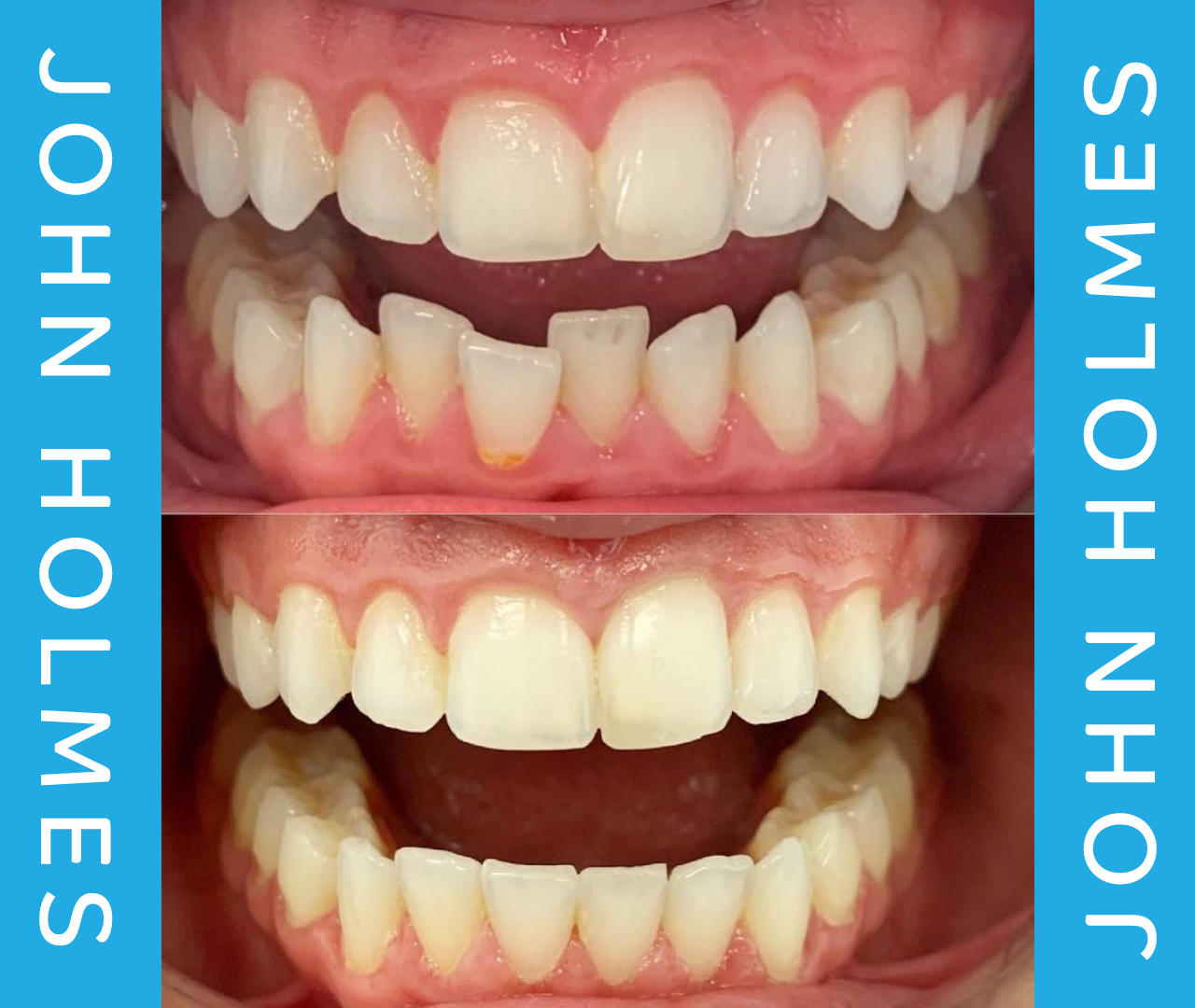 Invisalign Teeth Straightening Dental Treatment John Holmes Swaffham Kings Lynn Norfolk Norwich